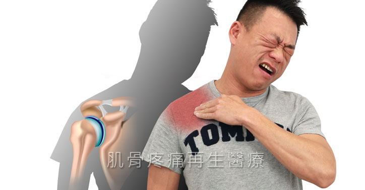 尤稚凱醫師 大多肩痛源自肩峰鎖骨關節 包括五十肩和旋轉肌腱撕裂傷 肌骨疼痛再生醫療blog