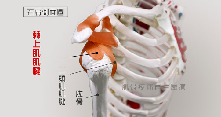 肩旋轉肌腱撕裂傷最常發生於棘上肌肌腱
