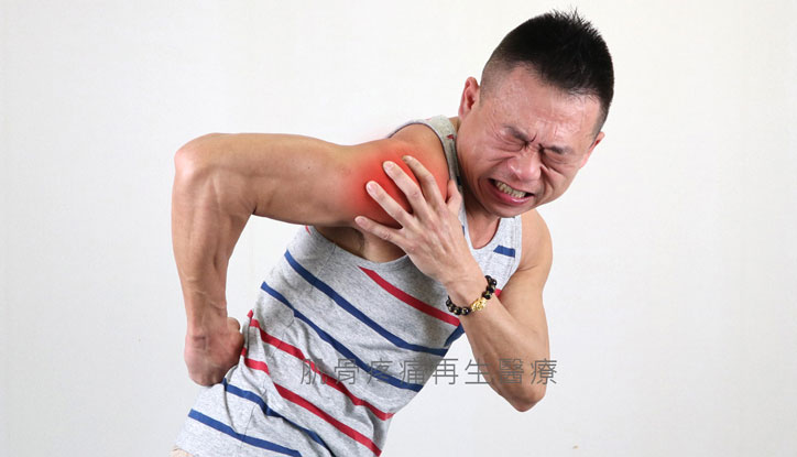 肩旋轉肌腱撕裂傷要強力修復裂傷避免併發五十肩