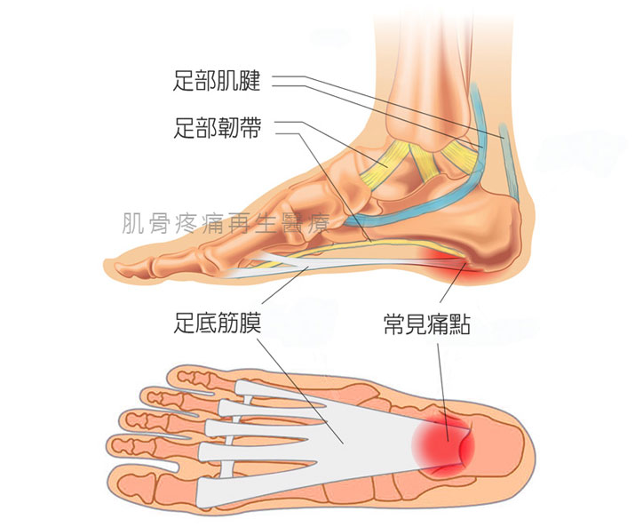 足底筋膜常見痛點解剖圖